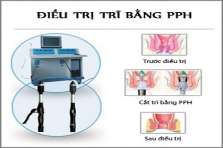 Cắt trĩ bằng phương pháp PPH